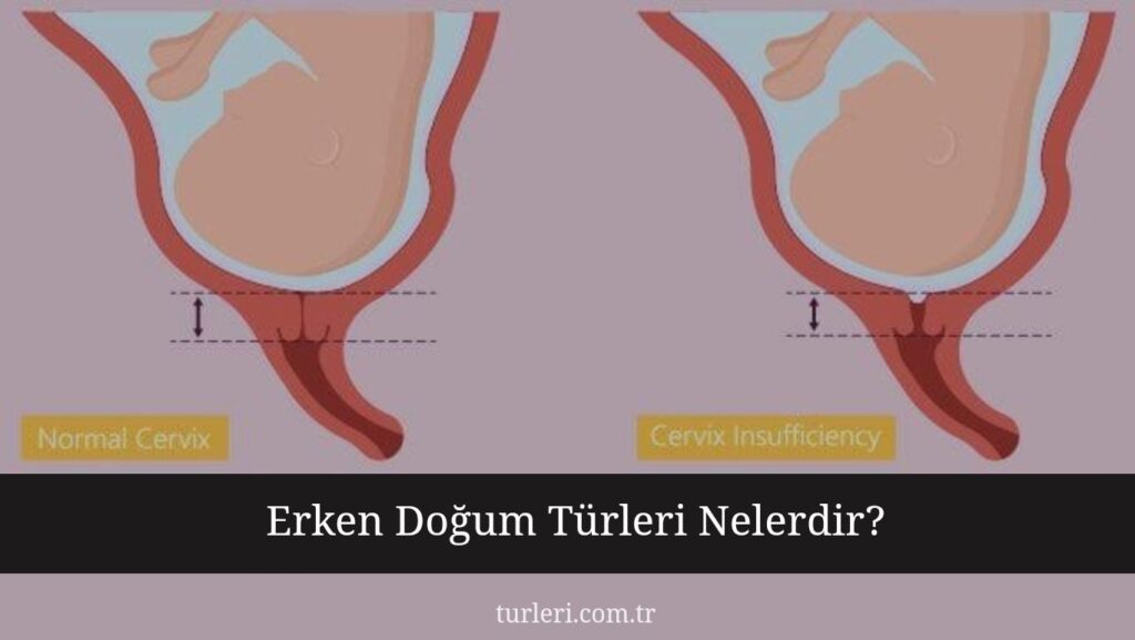 Erken Doğum Türleri Nelerdir?