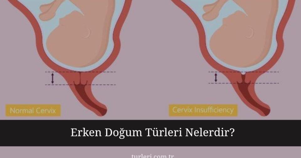 Erken Doğum Türleri Nelerdir?